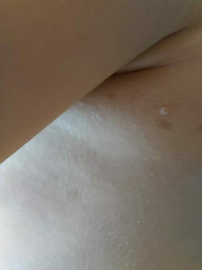 Dětské nemoci | Neurofibromatóza u 18m dítěte