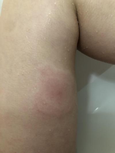 Zdravotní potíže dospělých | Nateklé bolestivé stehno a klíště