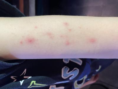 Alergie a ekzémy | Pupínky - svědivé puchýřky