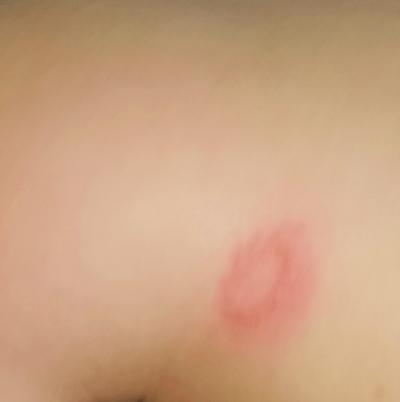 Miminko | Červené fleky u malé holčičky