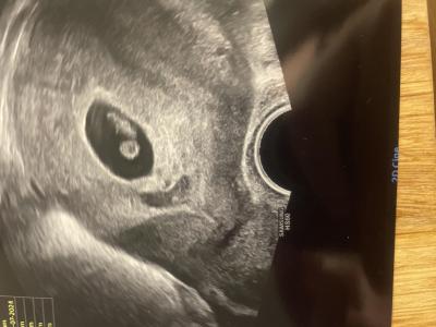 Těhotenství | Vidíte na ultrazvuku jedno, nebo dvě mimča?