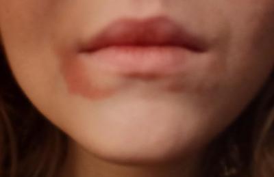 Alergie a ekzémy | Co to je? Ústa, vyrážka,...