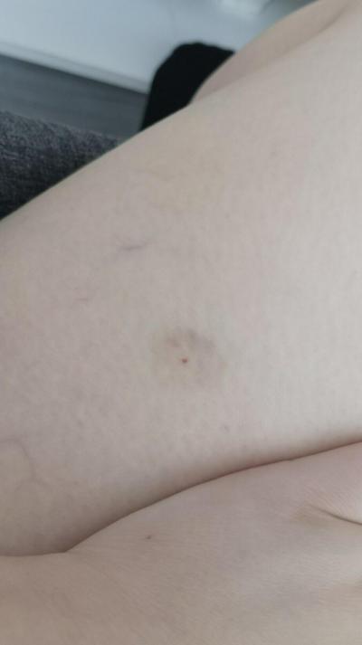Alergie a ekzémy | Nespecifický flek po klíštěti