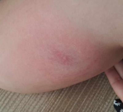 Zdravotní potíže dospělých | Absces v klitorisu
