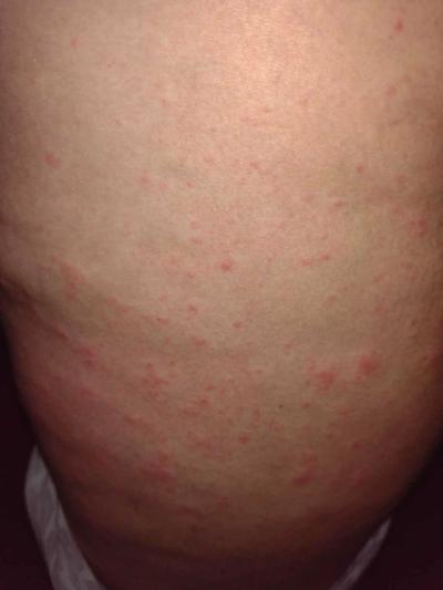 Alergie a ekzémy | Ekzém, Svrab nebo Alergie ?