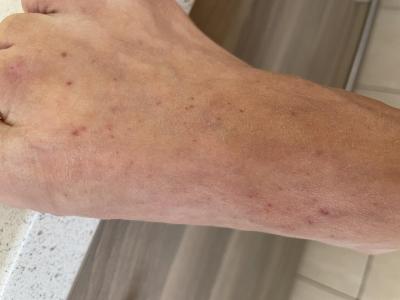 Zdravotní potíže dospělých | Petechie u dospeleho na nohou