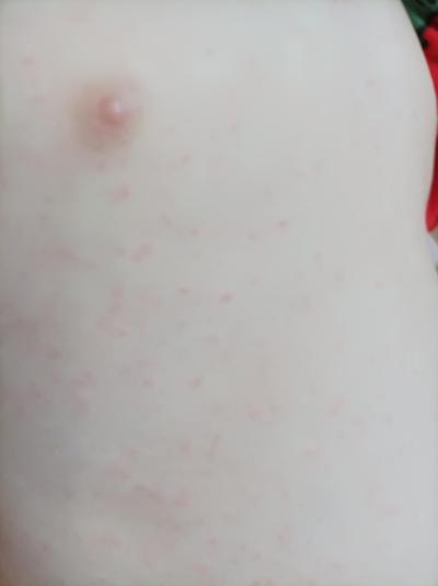 Dětské nemoci | Vyrážka u syna 3roky