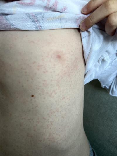 Dětské nemoci | Copak je to za vyrážku?