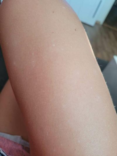 Zdravotní potíže dospělých | Bílé skvrnky po těle