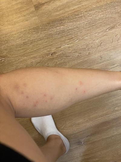 Zdravotní potíže dospělých | Štěnice, nebo blecha?