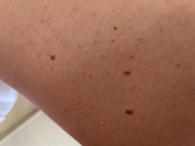 Zdravotní potíže dospělých | Petechie u dospeleho na nohou