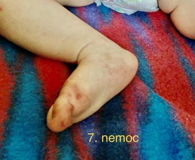 Dětské nemoci | Zkušenosti 7.nemoc