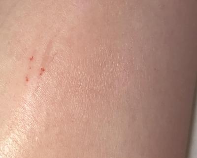 Zdravotní potíže dospělých | Bed bugs