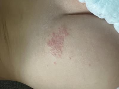 Alergie a ekzémy | Vyrážka na hýždi.