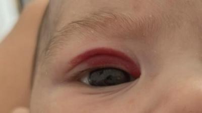 Alergie a ekzémy | Je to andělské polibeni?
