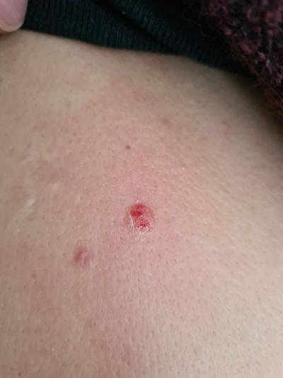 Zdravotní potíže dospělých | Bolesti zad a pasovy opar?