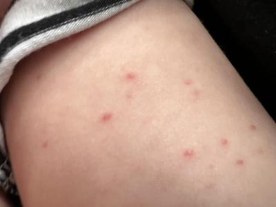 Batole (12 až 36 měsíců) | Meningitida vyrazka?