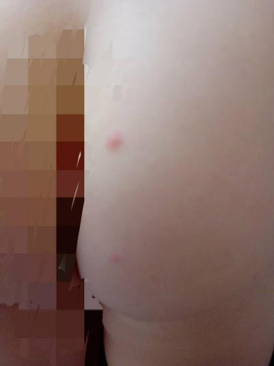 Dětské nemoci | Holky jsou to neštovice