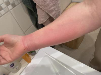 Zdravotní potíže dospělých | Na pohotovost? Opařenina