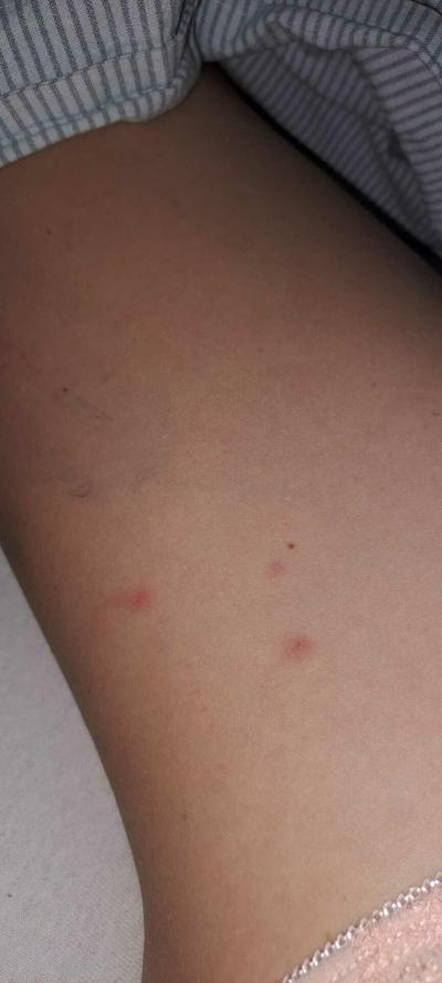 Alergie a ekzémy | Jsou toto štípance od štěnic??