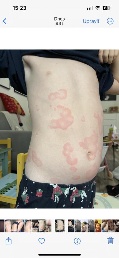 Předškoláček (3 až 6 let) | Ohraničené fleky po celém těle