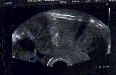 Snažení | HCG 1600 20 DPO přes IVF