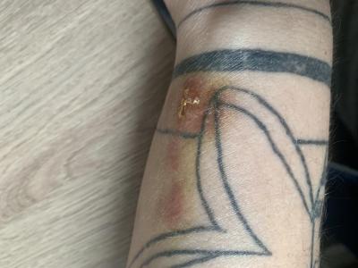Zdravotní potíže dospělých | Červené fleky na ruce