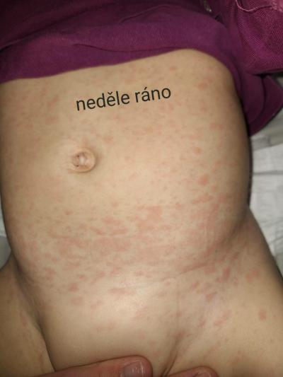 Dětské nemoci | Horečky u dětí
