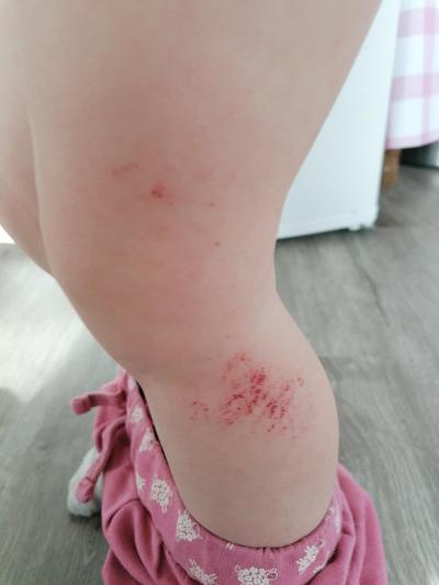 Batole (12 až 36 měsíců) | Vyrážka u kolena