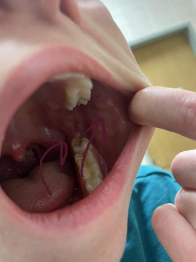 Zdravotní potíže dospělých | Asi růst moudráku + odřená dáseň