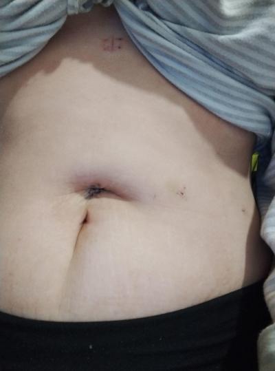 Zdravotní potíže dospělých | Laparoskopie a prohlubeň v těle