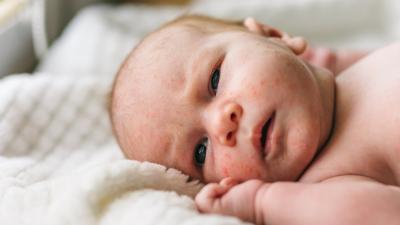 Co dělat při léčbě spalniček?