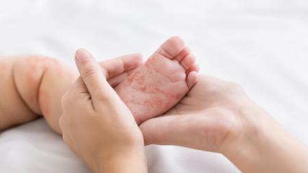 Sedmá nemoc: Jaké jsou příznaky a jak ji léčit?
