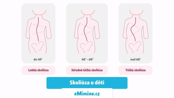 Skolióza páteře u dětí. Zaměřte se na posílení zádových svalů.
