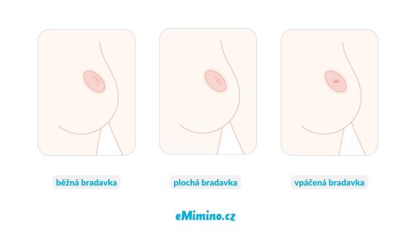Jak vypadají vpáčené bradavky?