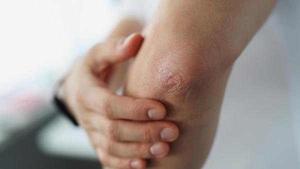 Jaké zkušenosti se psoriázou mají uživatelky eMimina?
