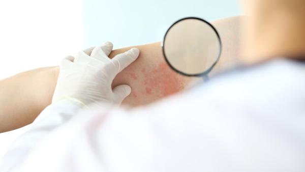 Jak se léčí psoriáza?