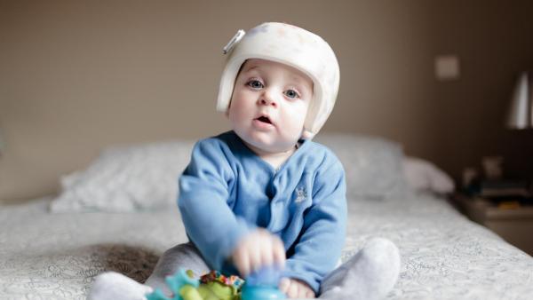 Helmička pro miminka neboli kraniální remodelační ortéza je úspěšná zejména u těžkých deformací lebky.