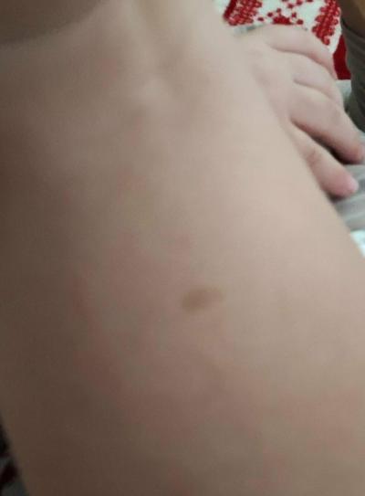 Dětské nemoci | Neurofibromatóza u 18m dítěte