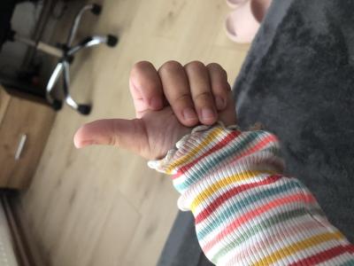 Batole (12 až 36 měsíců) | Zkroucený palec 2letá holčička