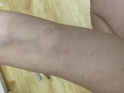 Alergie a ekzémy | Na kůži fleky Švédive