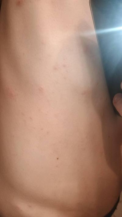 Alergie a ekzémy | Vyrážka / pupínky, svědění...