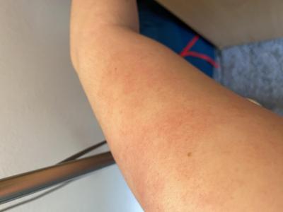 Alergie a ekzémy | Červené fleky po koupání
