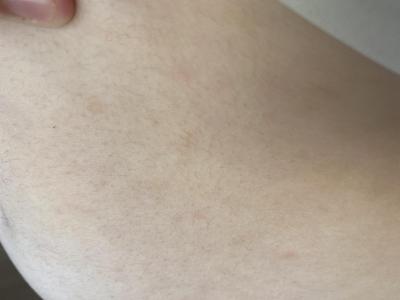 Zdravotní potíže dospělých | Jsou to cesticky svrabu?