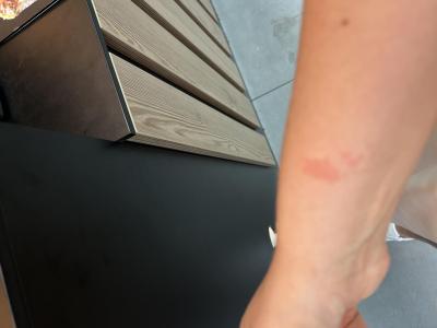Alergie a ekzémy | Alergie? Exém?