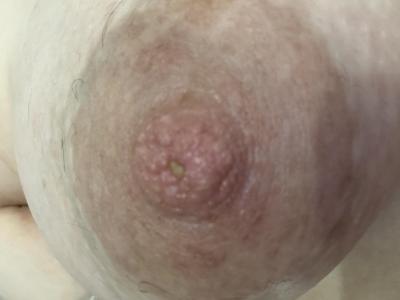 Gynekologické potíže | Podivná Bradavka