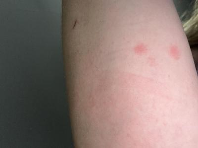 Alergie a ekzémy | Skvrnky na kůži.