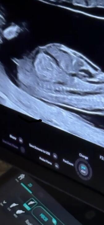 Těhotenství | Holka nebo kluk? UTZ 13+1