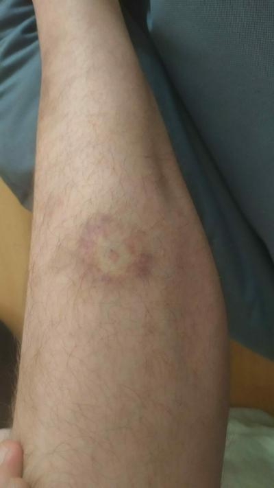 Alergie a ekzémy | Midřina nebo borelióza