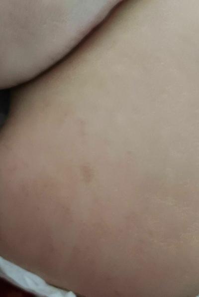 Dětské nemoci | Neurofibromatóza u 18m dítěte